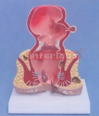 DESKTYPE COMMOM PATHOLOGIES MODEL OF RECTUM